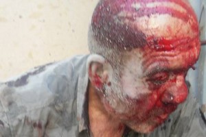 В Ереване пятеро жестоко избили ветеран Арцахской войны (фото)