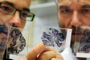 Ученые хотят лечить болезнь Альцгеймера генной терапией