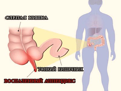 Острый аппендицит