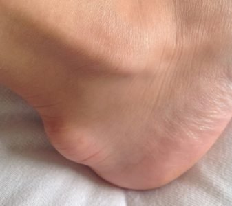 Боли в пятках – причины возникновения