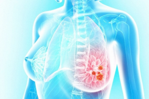 Основные симптомы развития рака груди