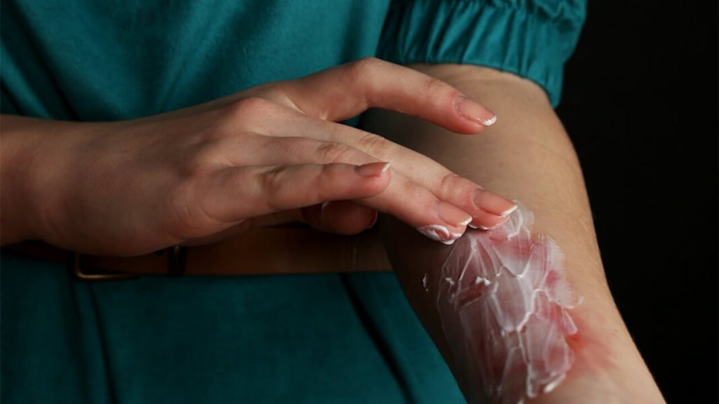 Эффективные средства при лечении ожогов