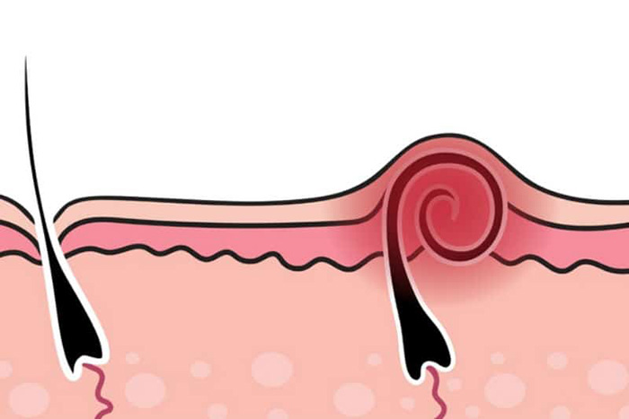 Простые средства для устранения вросших волос