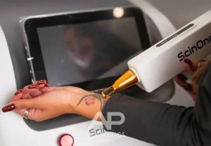 Удаление тату неодимовым лазером: особенности технологии и возможности аппаратов