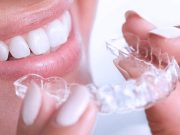 Элайнеры: эффективно и удобно